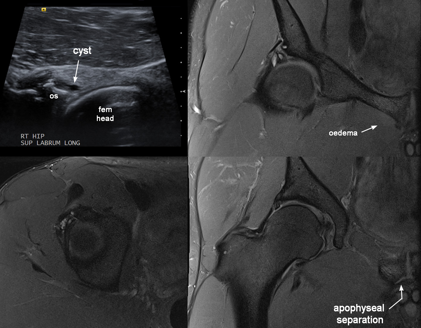 Figure 2 for case Concomitant acetabular labral tear and pubic apophysitis with partial apophyseal separation
